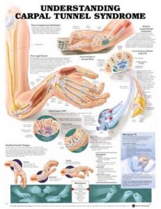 Understanding Carpal Tunnel Syndrome