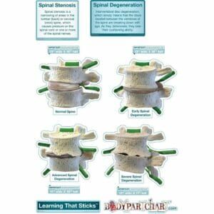 Spinal Degeneration - Labeled Removable Wall Graphic