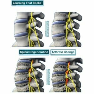 Spinal Degeneration Series - Removable Wall Graphic