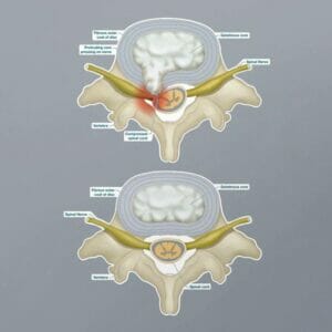 Prolapsed Disc - Labeled Removable Wall Graphic