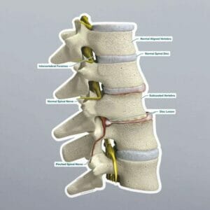 Subluxation - Labeled Removable Wall Graphic