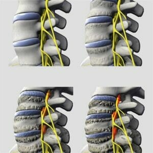 Spinal Degeneration Series - Removable Wall Graphic