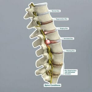 Spine Conditions - Labeled Removable Wall Graphic - Small 12" x 17"