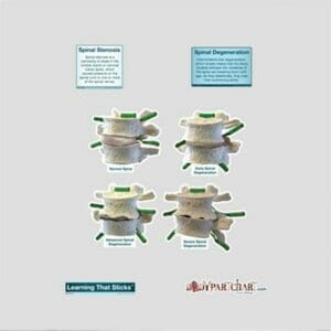 Spinal Degeneration - Labeled Removable Wall Graphic