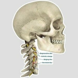 Lateral Cervical Spine Conditions - Labeled Removable Wall Graphic