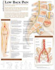 Understanding Low Back Pain Anatomical Chart - Heavy Paper