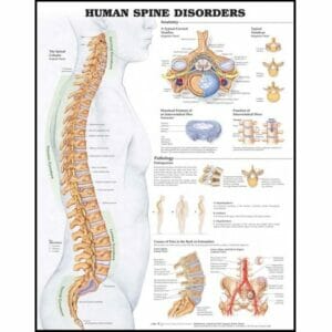 Human Spine Disorders Anatomical Chart - Heavy Paper