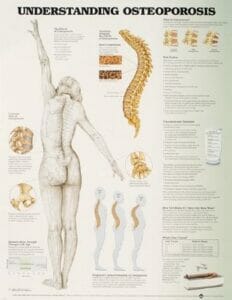 Understanding Osteoporosis