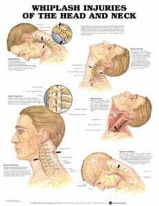 Whiplash Injuries